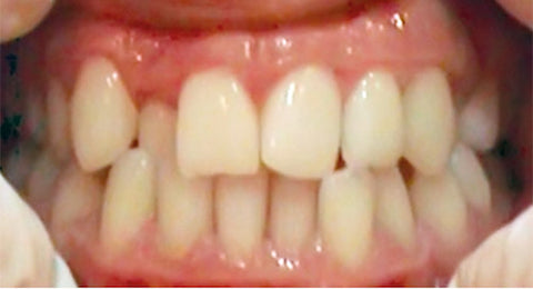 crowded teeth problem