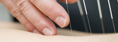 TCM Supplies NZ | Huanqui & Shen Long Acupuncture Needles