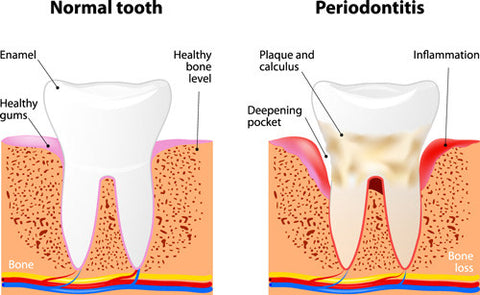 Periodontitus