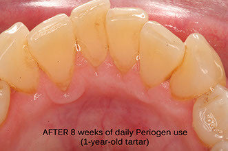 Plaque and tartar removed with Periogen