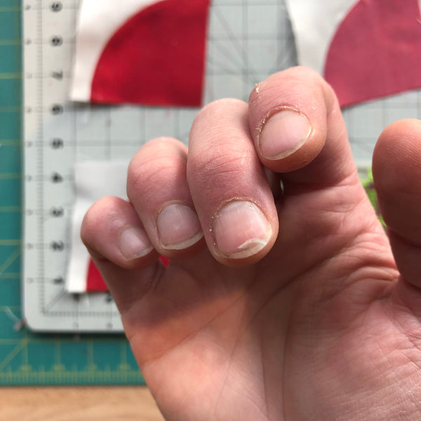 Quilting injury on finger nail