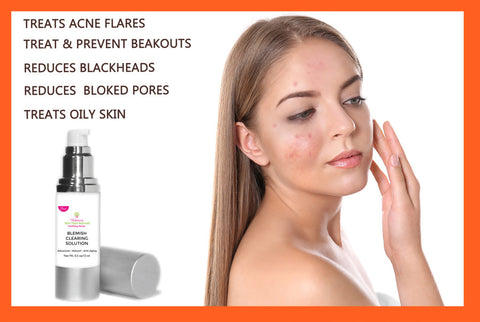 Victoria’s Celebrity Acne Pimples & Blemish Clearing Solution, Natural, Hormonal, Cystic Acne, Oil Control, Anti-Aging