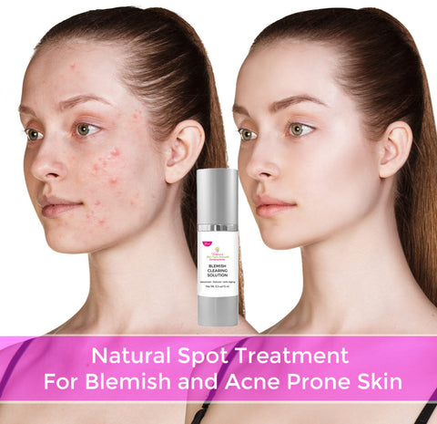 Victoria’s Celebrity Acne Pimples & Blemish Clearing Solution, Natural, Hormonal, Cystic Acne, Oil Control, Anti-Aging