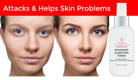 Victoria’s Celebrity Advanced Clarifying Toner Anti Aging & Acne Facial Toner –Anti-Aging, Acne, Breakouts, Wrinkles, Pigmentation 