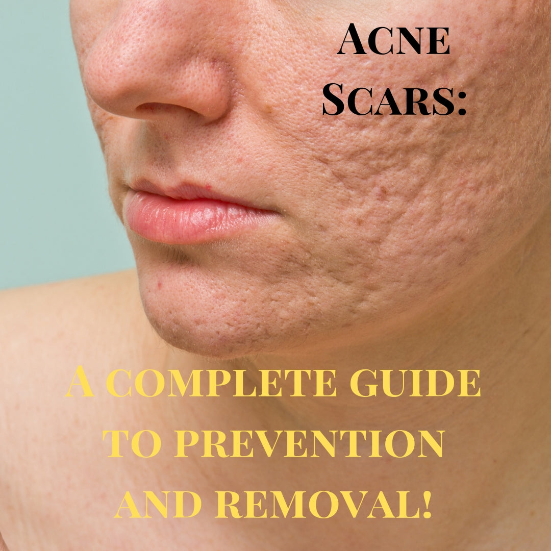 What Helps Acne Scars Go Away Naturally