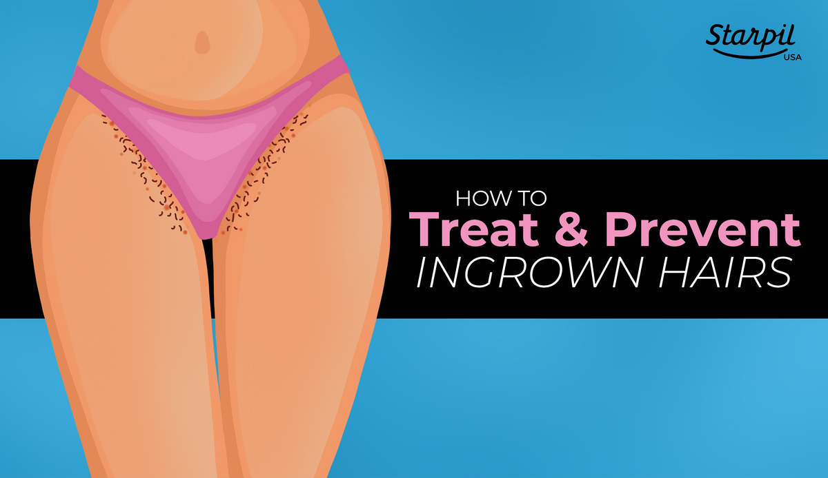 How to Treat & Prevent Ingrown Hairs After Waxing | Starpil Wax