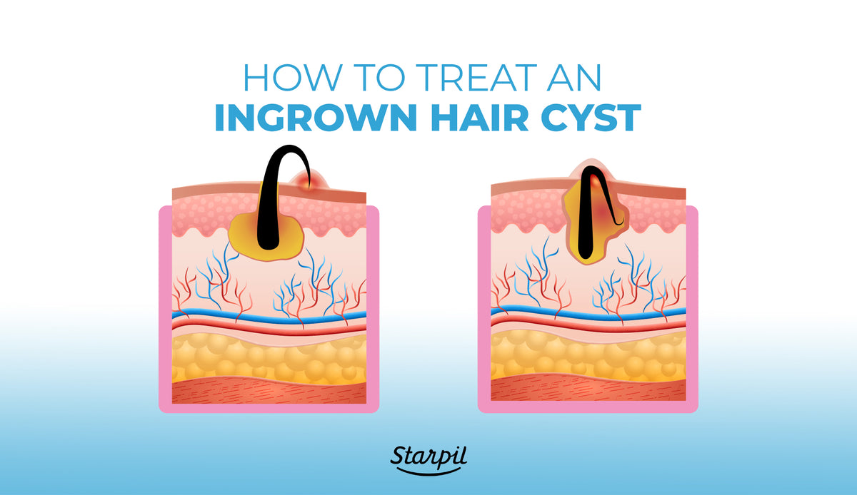 Ingrown Hair Cysts: Treatments, Causes & Symptoms | Starpil Wax