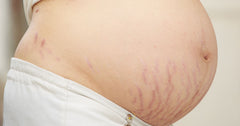 Deep scar lines Hollyberry cosmetics stretch mark prevention