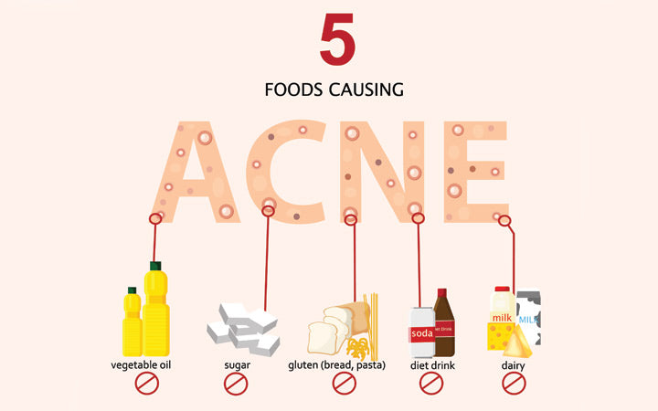 Acne Diet: 9 Foods That Cause Pimples(Plus ... - SkinKraft