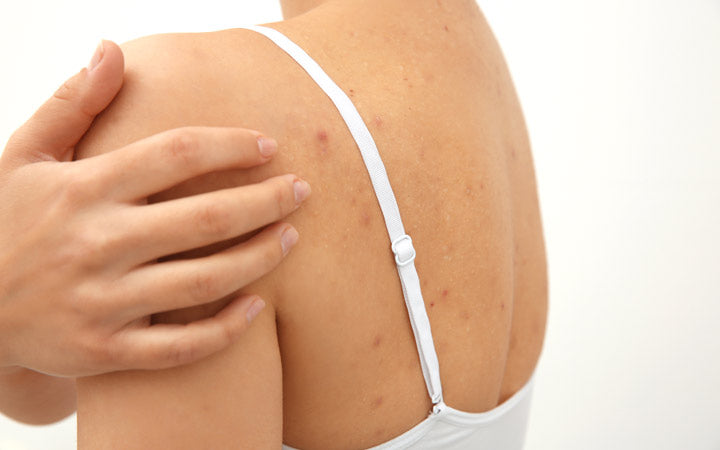 how to remove pimple scars from your back