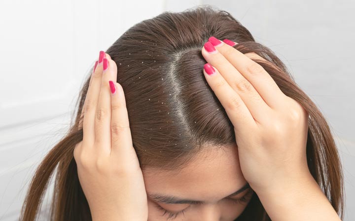 Dandruff Vs Psoriasis: What's The Difference? – SkinKraft