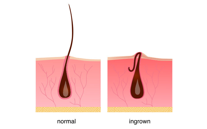 Ingrown Hair: Symptoms, Treatment & Prevention – SkinKraft