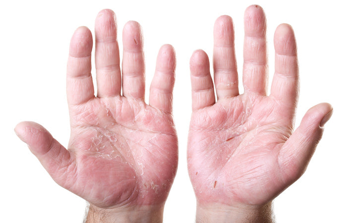 mild dermatitis herpetiformis on hands