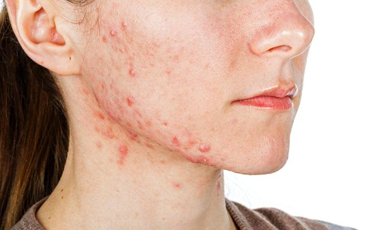 Acne severe body What Causes
