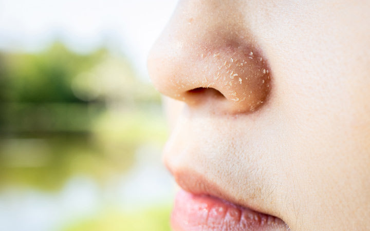 9 of Dry Around Nose & How To Treat It? SkinKraft