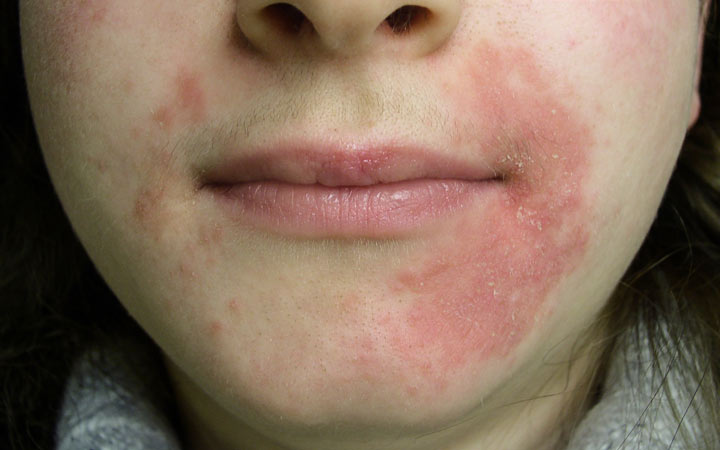 To how treat dermatitis naturally perioral Perioral Dermatitis