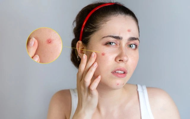 Pimple with pus popped keeps filling Big juicy