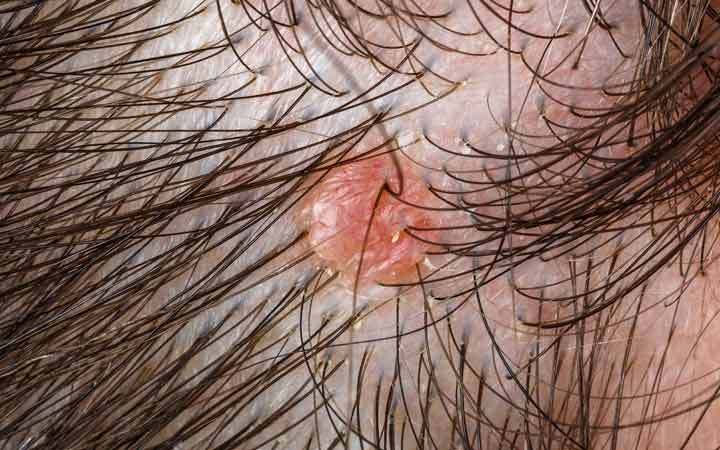 8 Types Of Scalp Folliculitis & Ways To Get Rid Of Them – SkinKraft