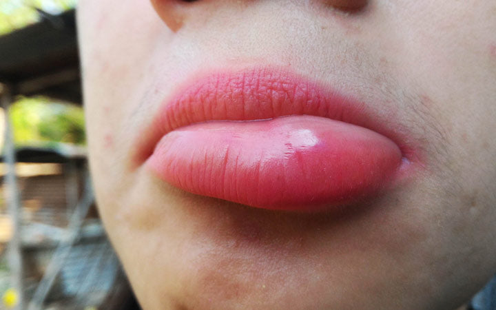 Swollen Lips: Causes, Home Remedies, Medical Treatments & Precautions –  SkinKraft