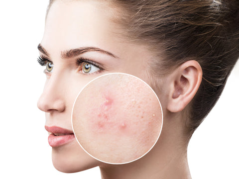 Acne or acne vulgaris