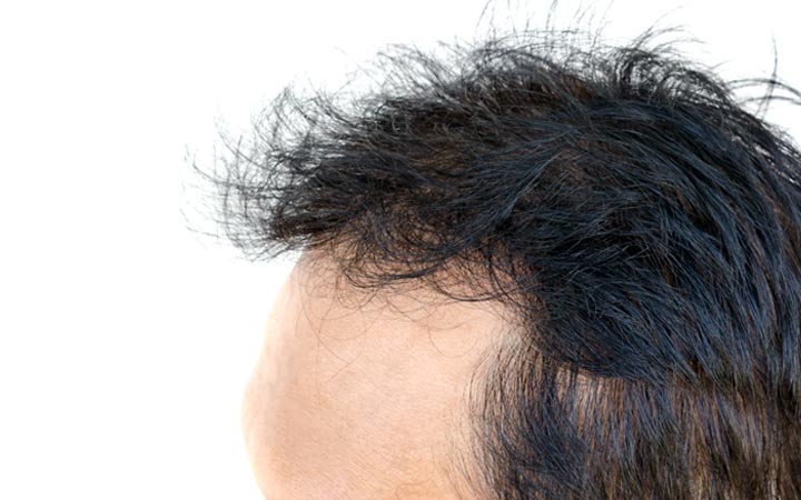 Man hair with Androgenetic Alopecia problem