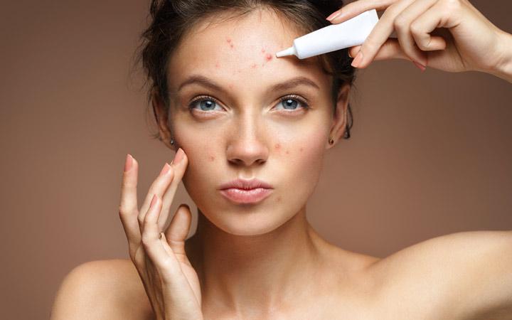 Woman applying cream to forehead acne