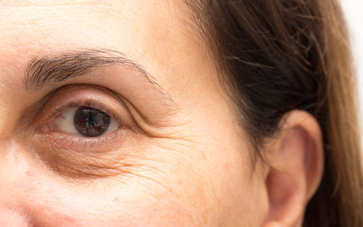 Woman showing puffy eyes