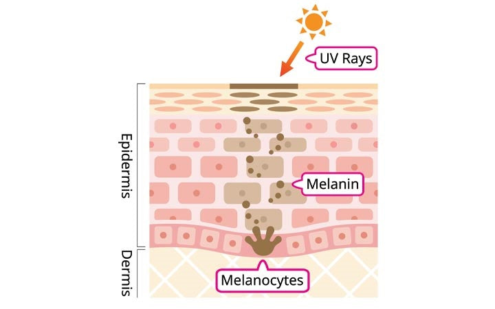 Hyperpigmentation causes