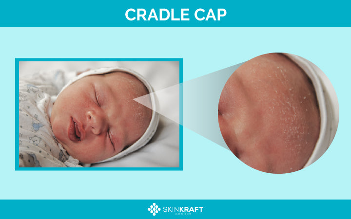Cradle Cap