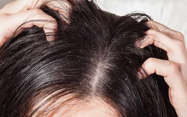 Woman hair with hair dandruff