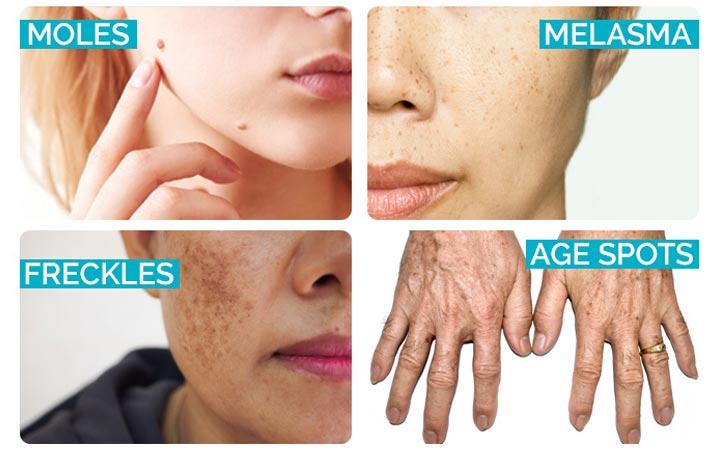Difference between moles, age spots, frecles, melasma