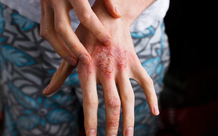 Woman hand with eczema