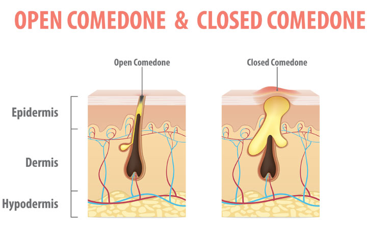 open comedone and closed  comedone