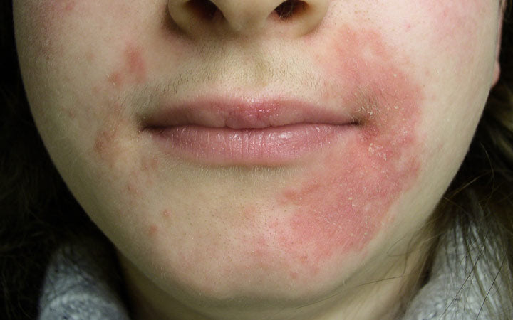 Perioral dermatitis on face