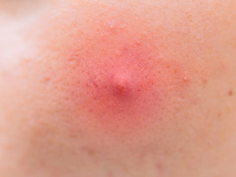 Acne Papules 