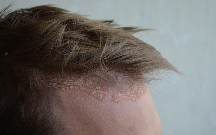 Psoriasis on forehead