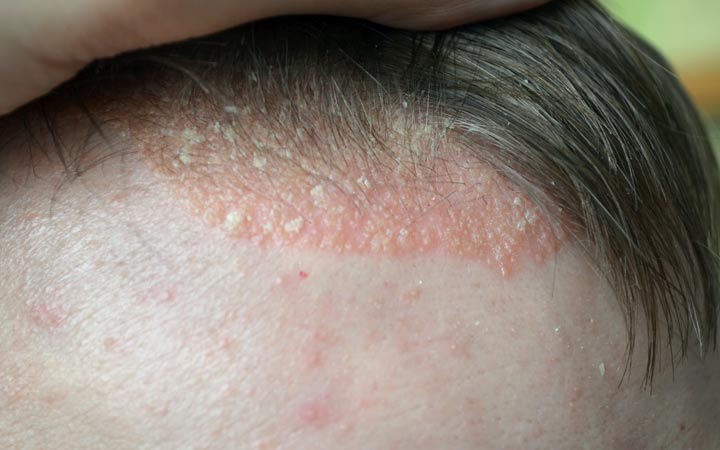 Woman hair with scalp psoriasis