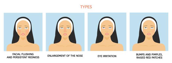 The-four-types-of-rosacea