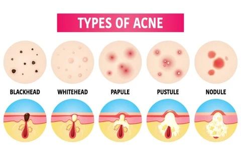 Types of Acne