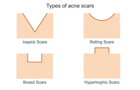 Types of Acne scars