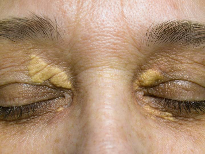 Xanthelasma