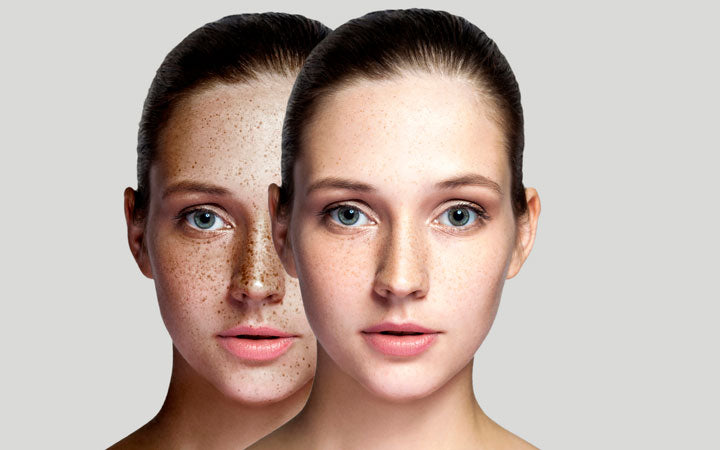 before and after woman face removing freckles on face