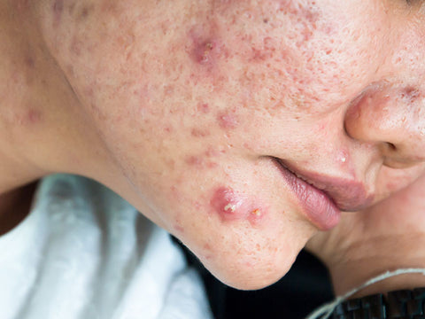 Acne Cysts 