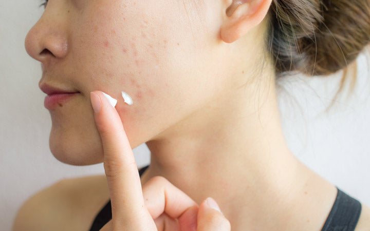 young asian woman applying cream for acne