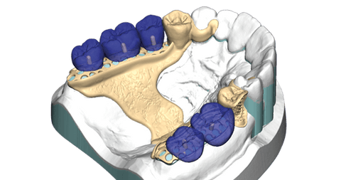 exocad PartialCAD (Flex Upgrade)