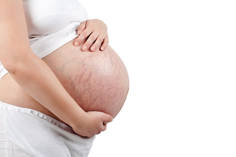 pregnancy skin issues stretch marks