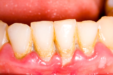 What do receding gums look like?