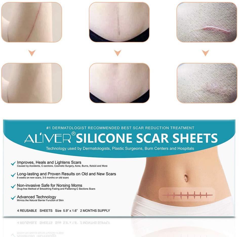 silicone pads for scars