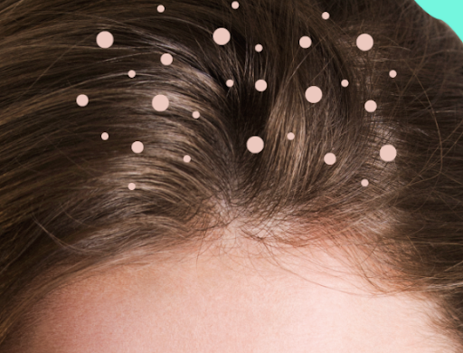 How to Get Rid of Itchy Scalp [Causes and Remedies]