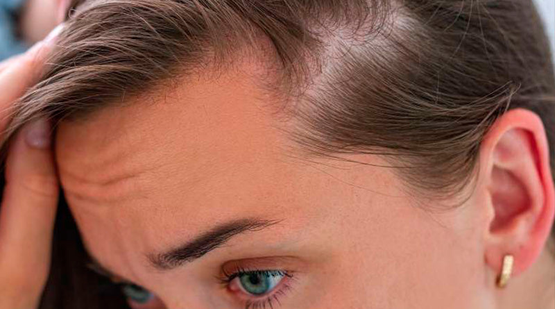 Alopecia Femenina – WIOHAIR